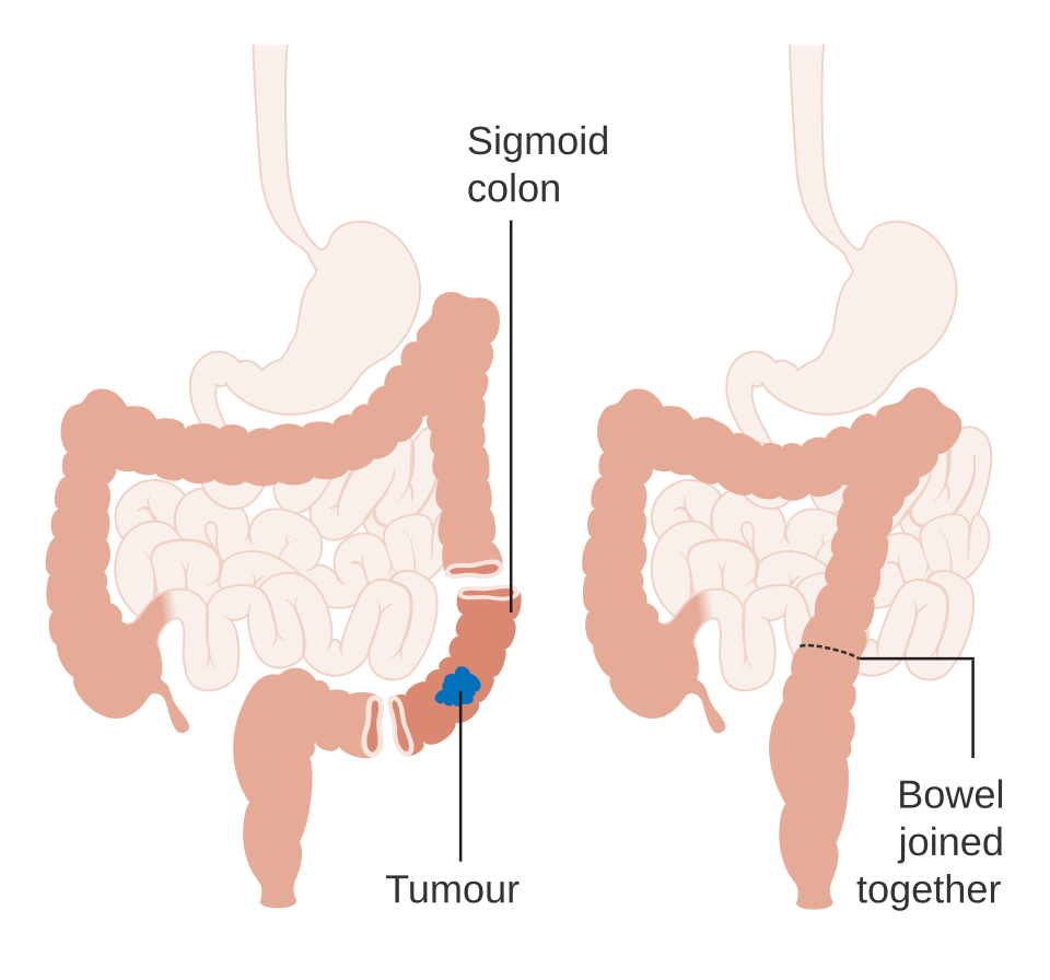 sigmoid colectomy.