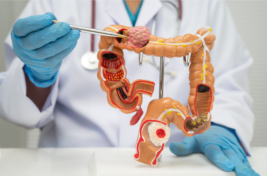 colorectal cancer